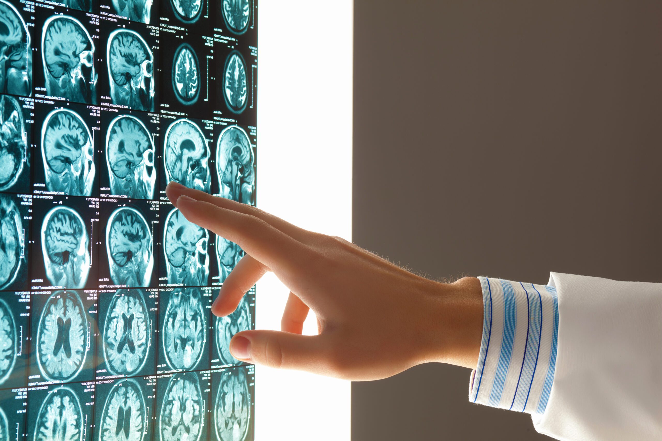 Brain Injuries from Medical Malpractice