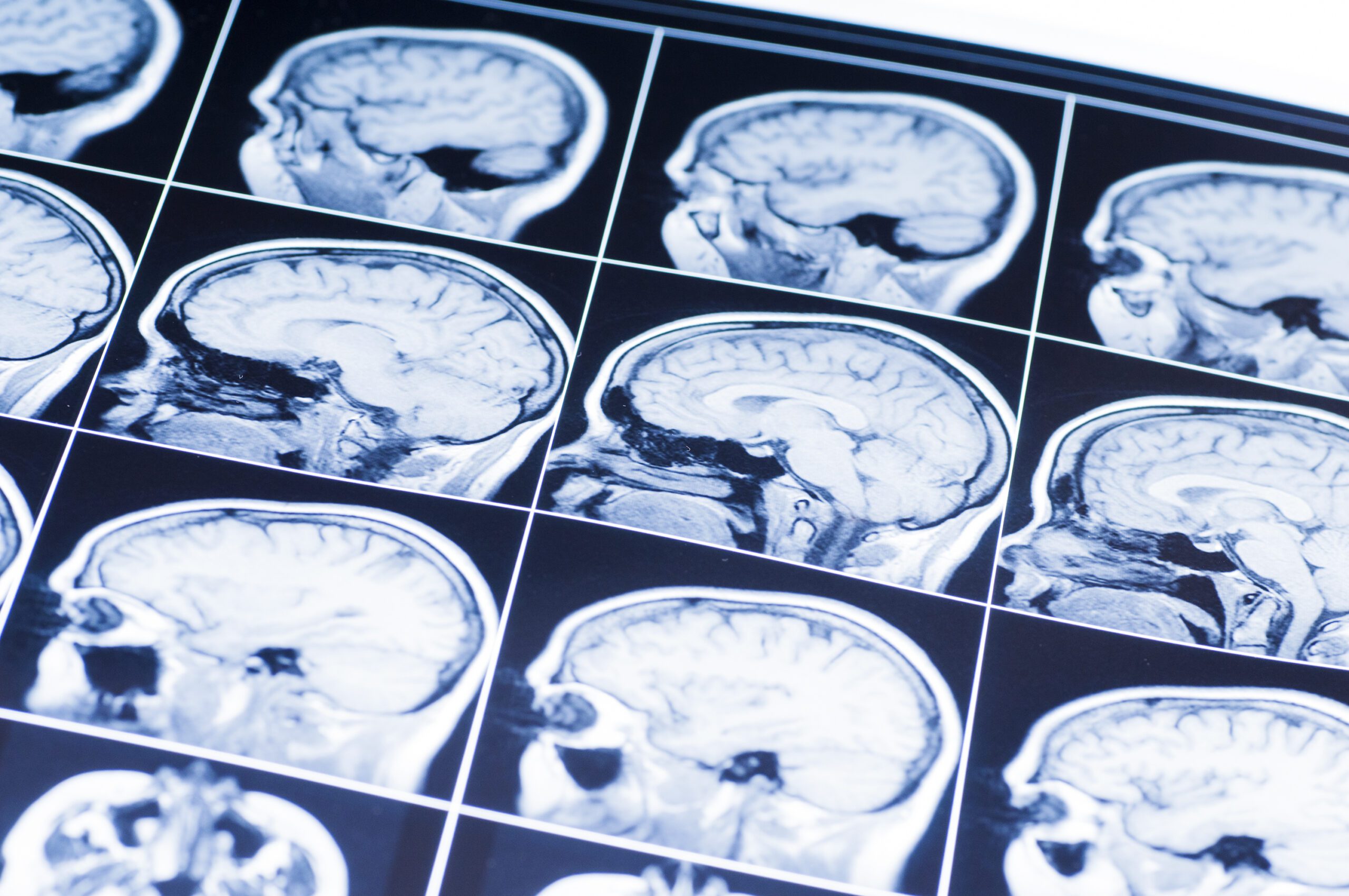 Brain Injuries in Newborns